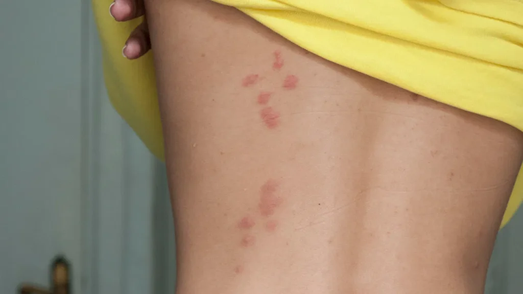 bed bug bites